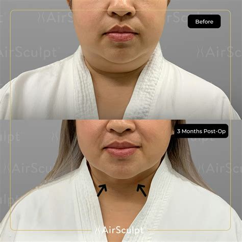 The number of treatments you&39;ll need will play a vital role in the total cost. . Airsculpt cost chin